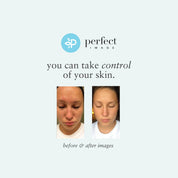 Glycolic 50% Gel Peel -Level 2