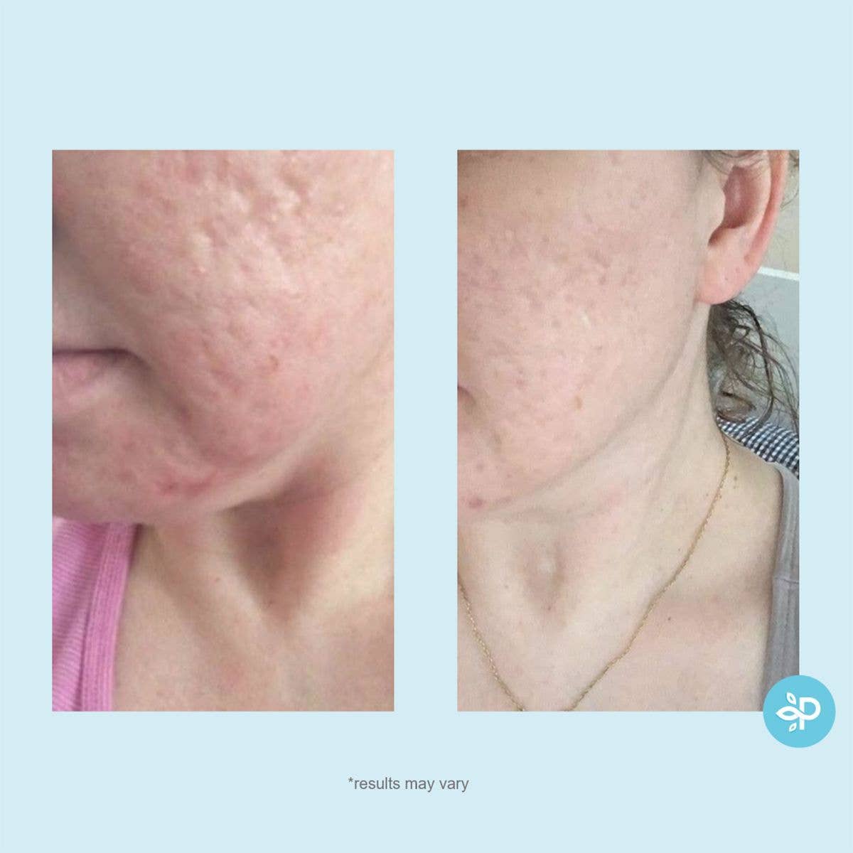 Glycolic 50% Gel Peel -Level 2