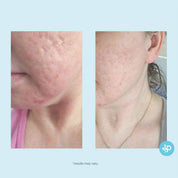 Glycolic 50% Gel Peel -Level 2