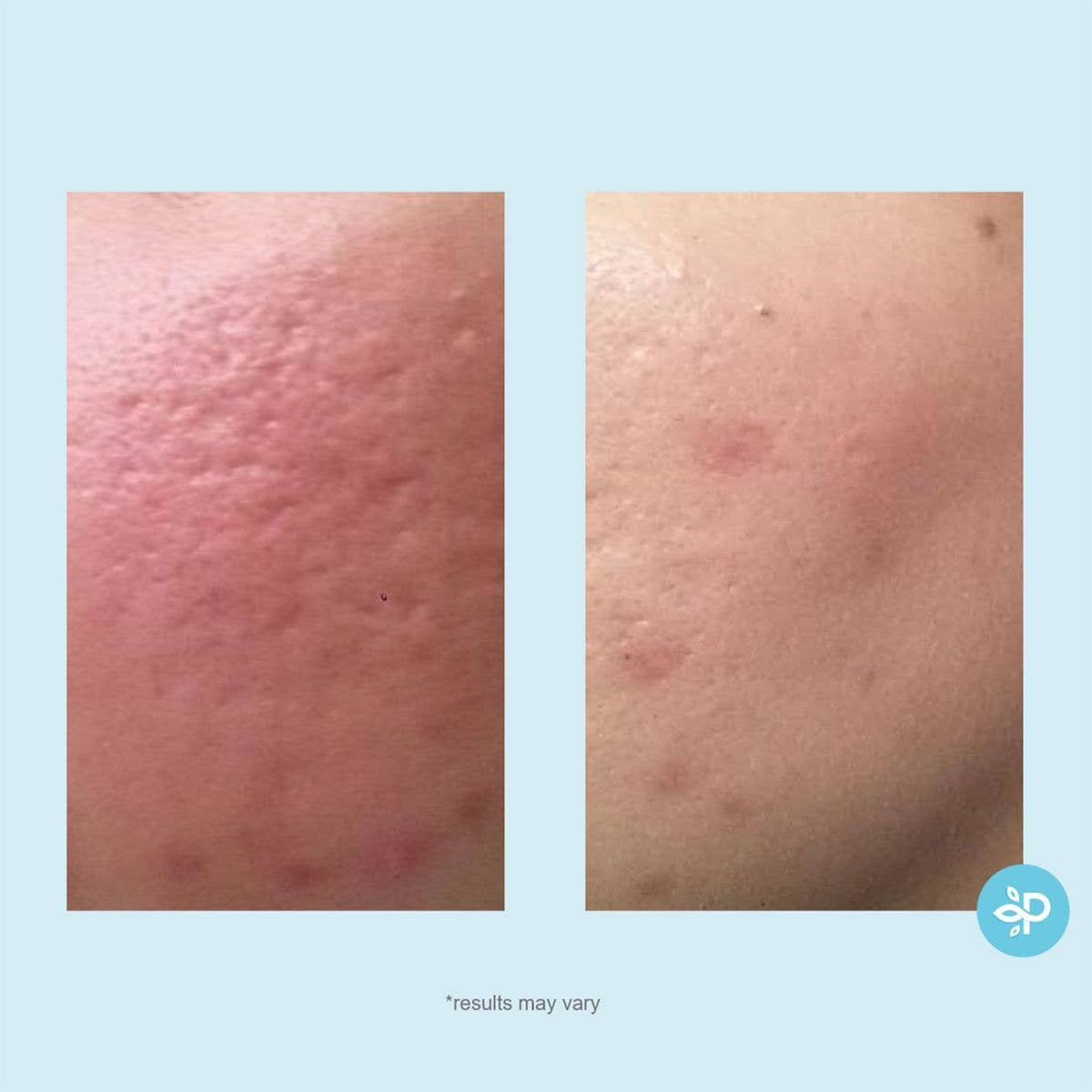 Lactic 50% Gel Peel - Level 2