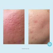 Lactic 50% Gel Peel - Level 2