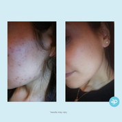 Salicylic 20% Gel Peel - Level 2