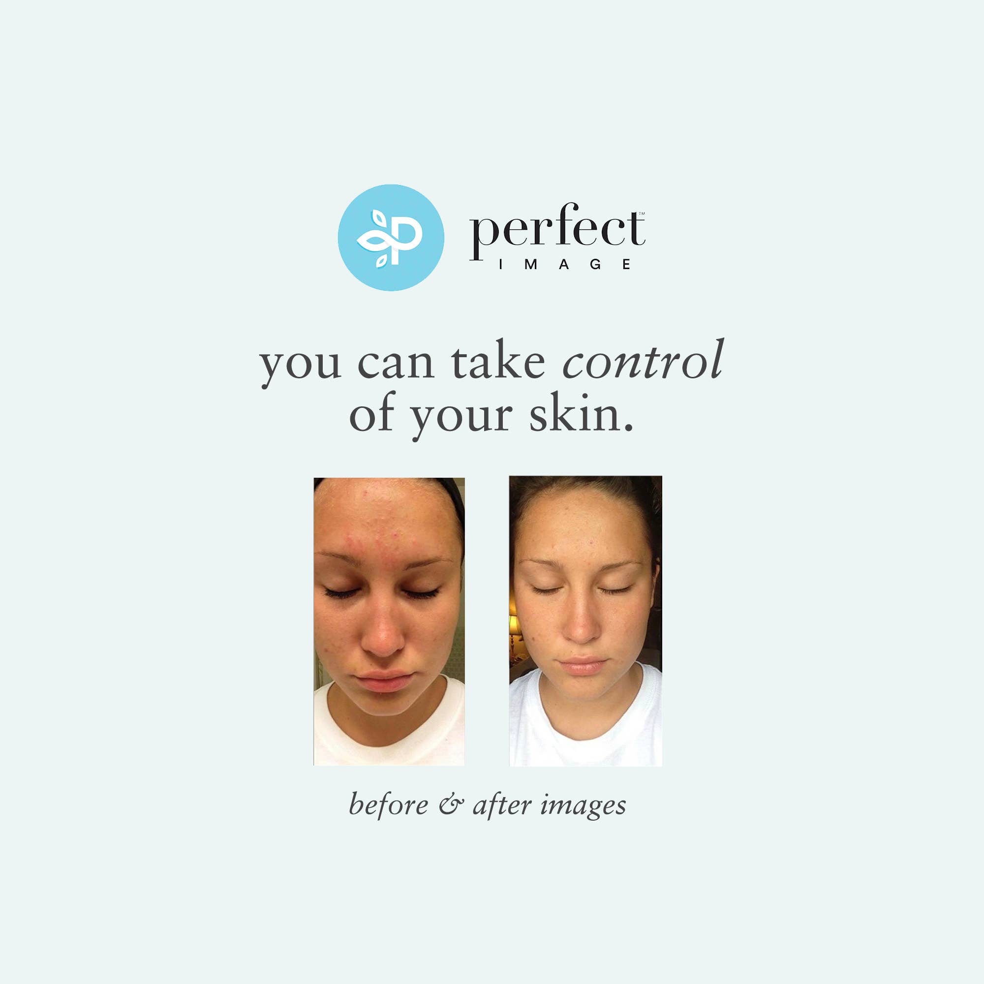 Glycolic 50% Gel Peel -Level 2