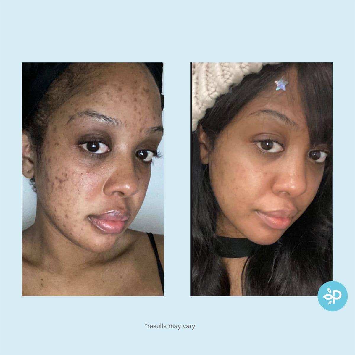 Salicylic 10% Gel Peel (Daily-Use)