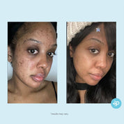 Salicylic 10% Gel Peel (Daily-Use)